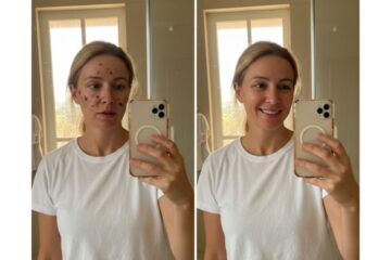 Antes e Depois do Clareador Nutralfit Minha Pele Mudou Mesmo